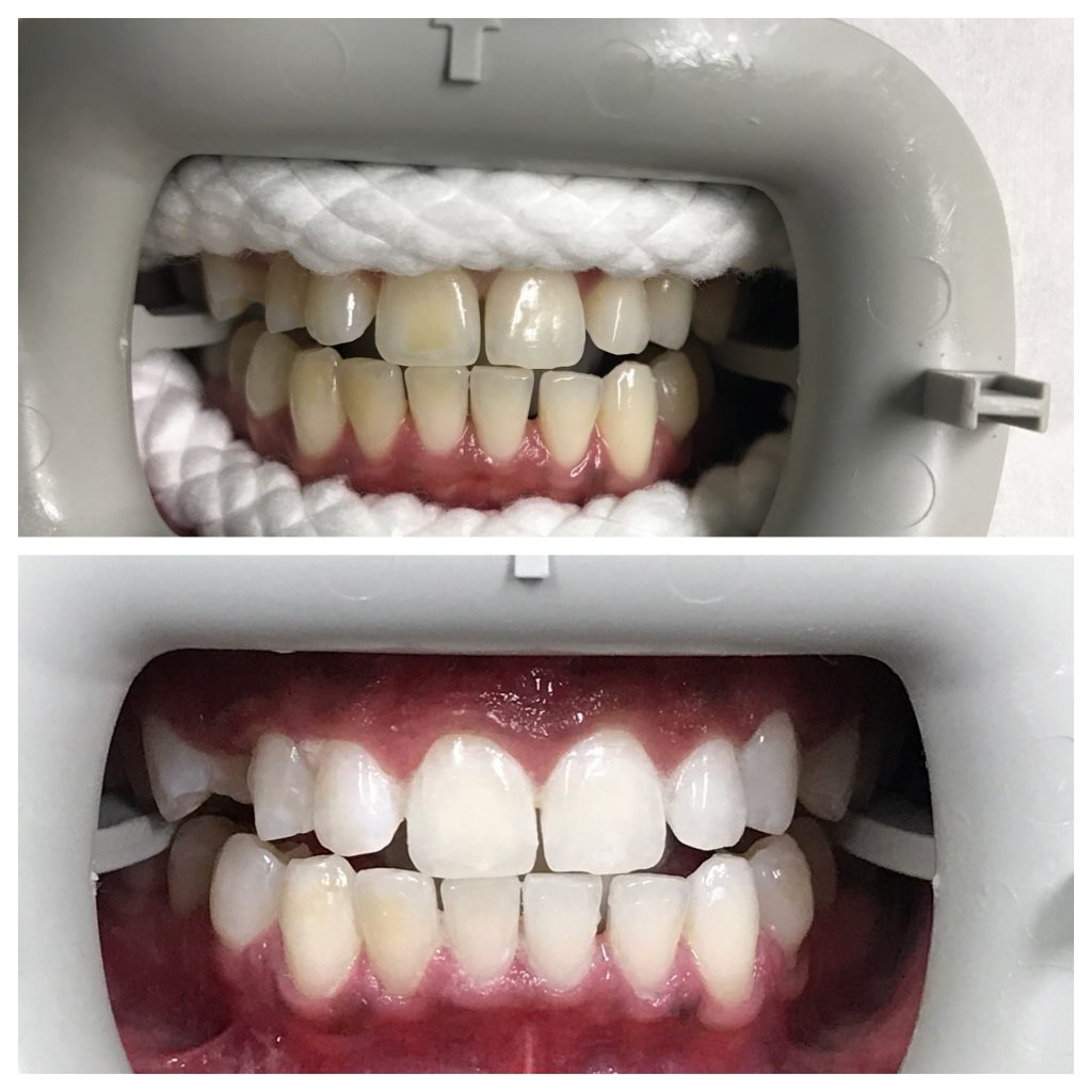 Bleaching Before And After