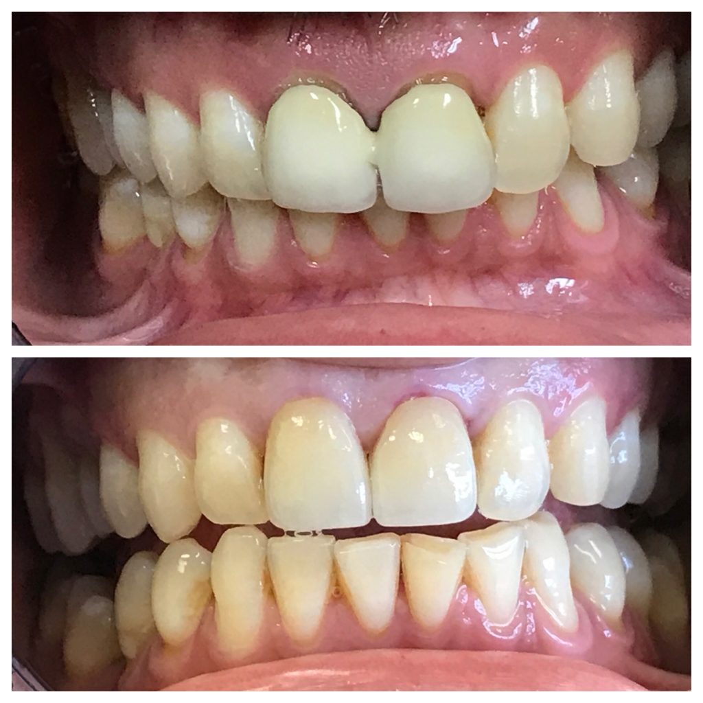Front Crown Repalcement Before And After