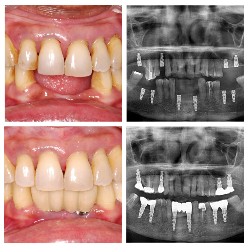 Implant2