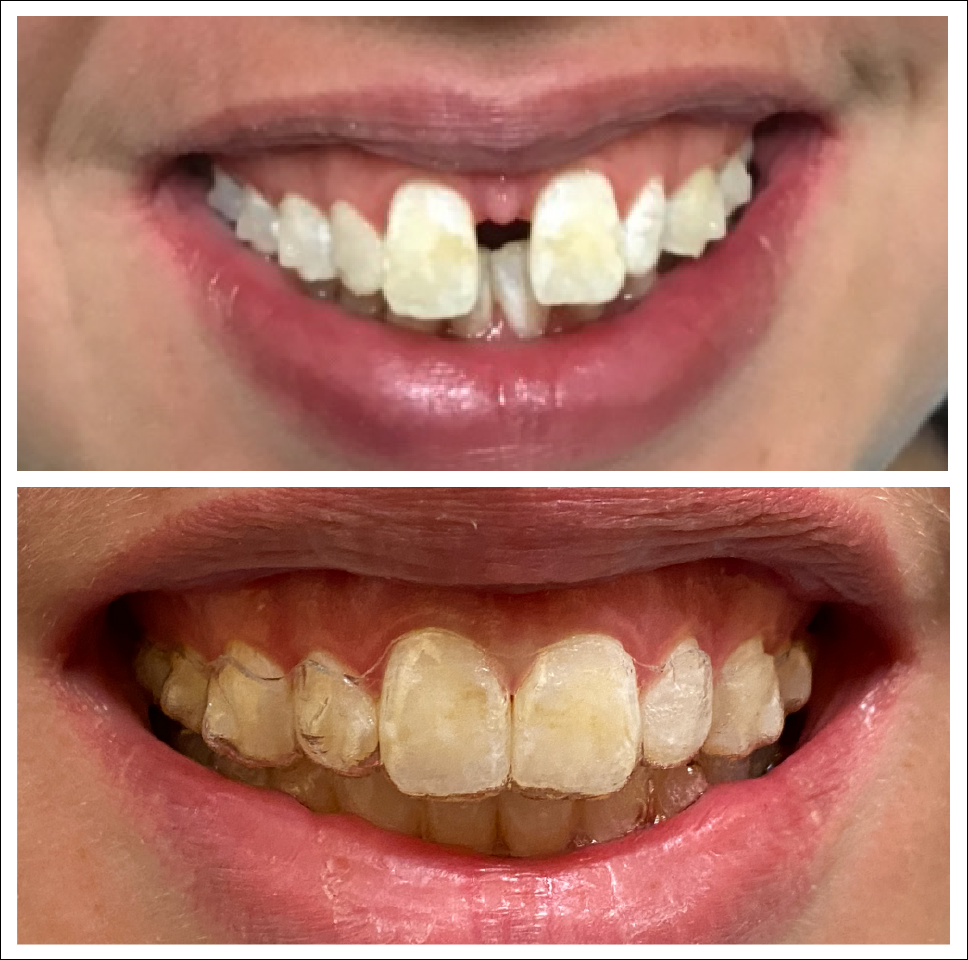 Invisalign 01