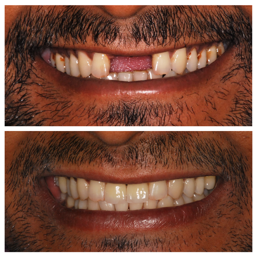 Missing Front Tooth 01