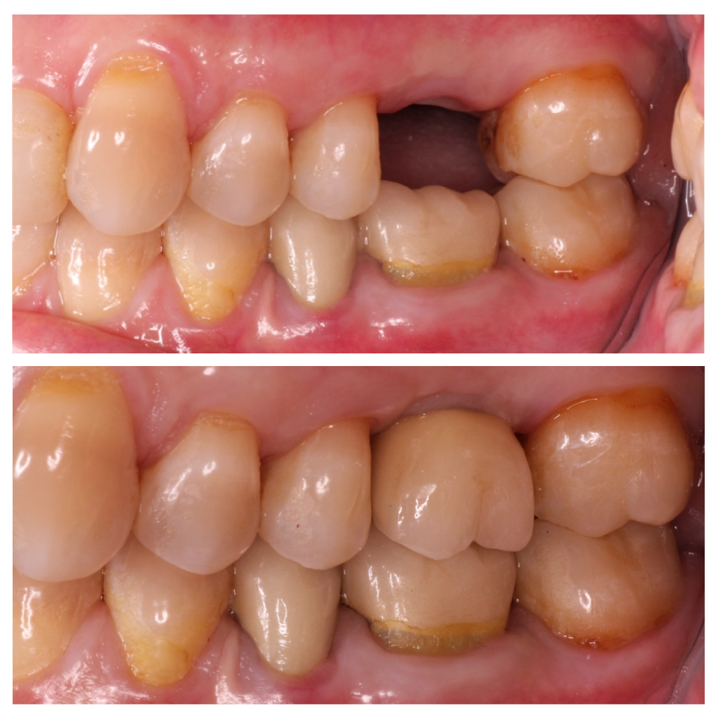 Single Tooth Implant
