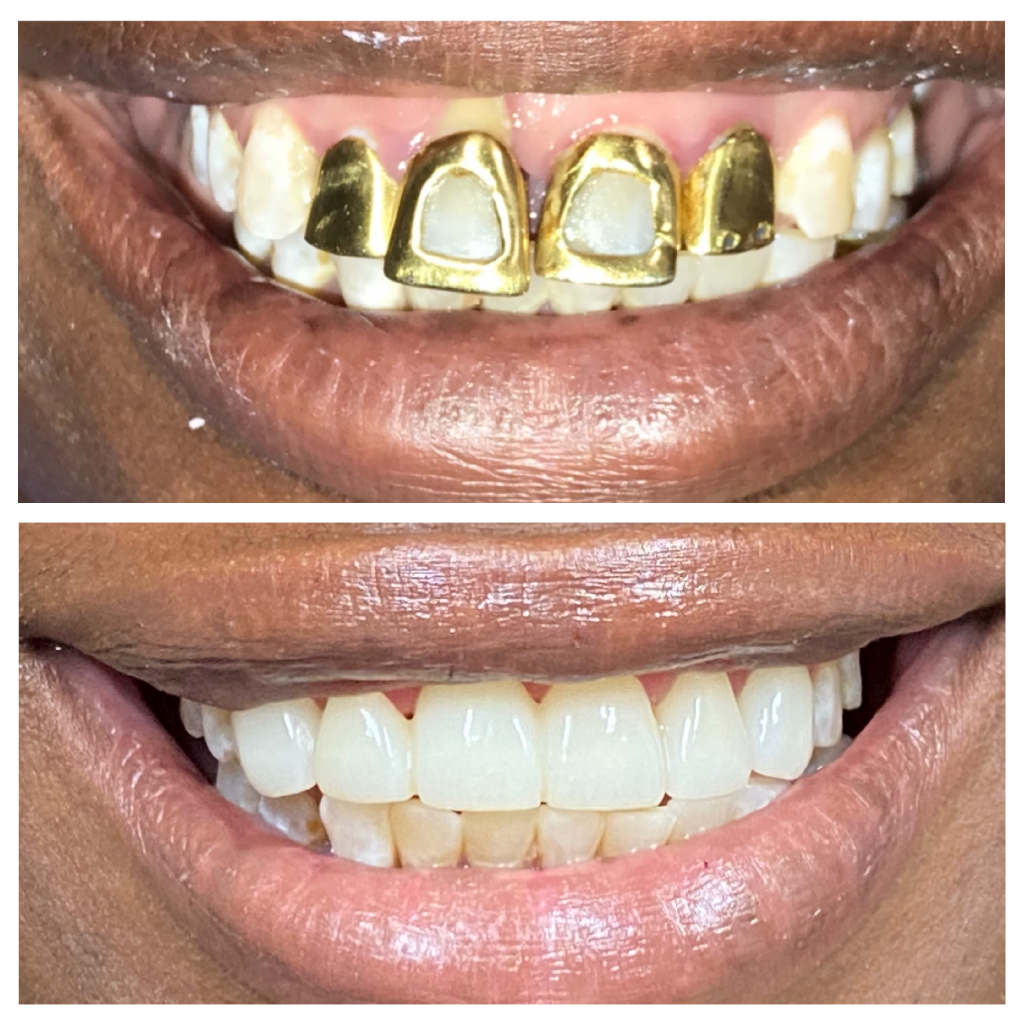 Smile Makeover3 01