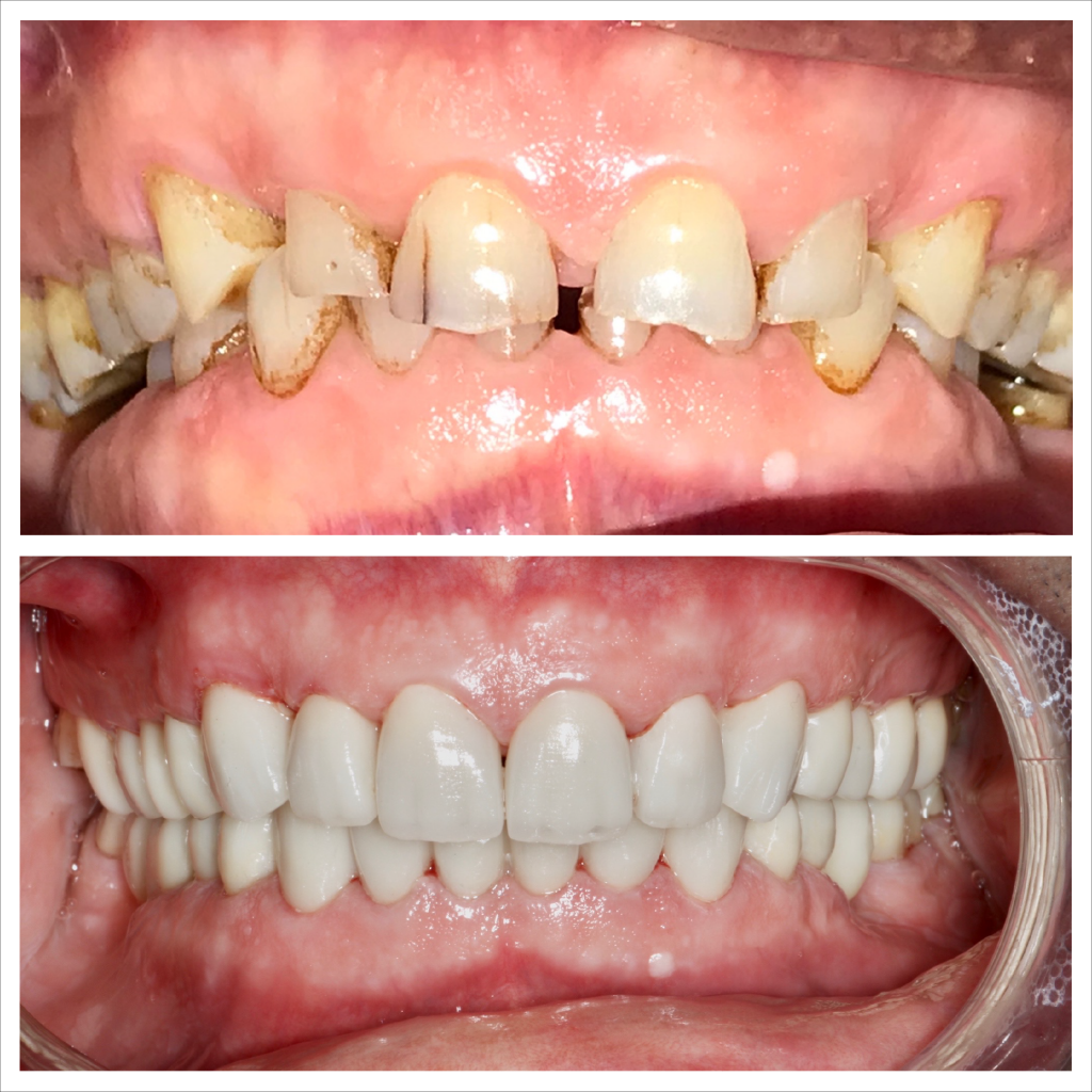 Smile Makeover1 01