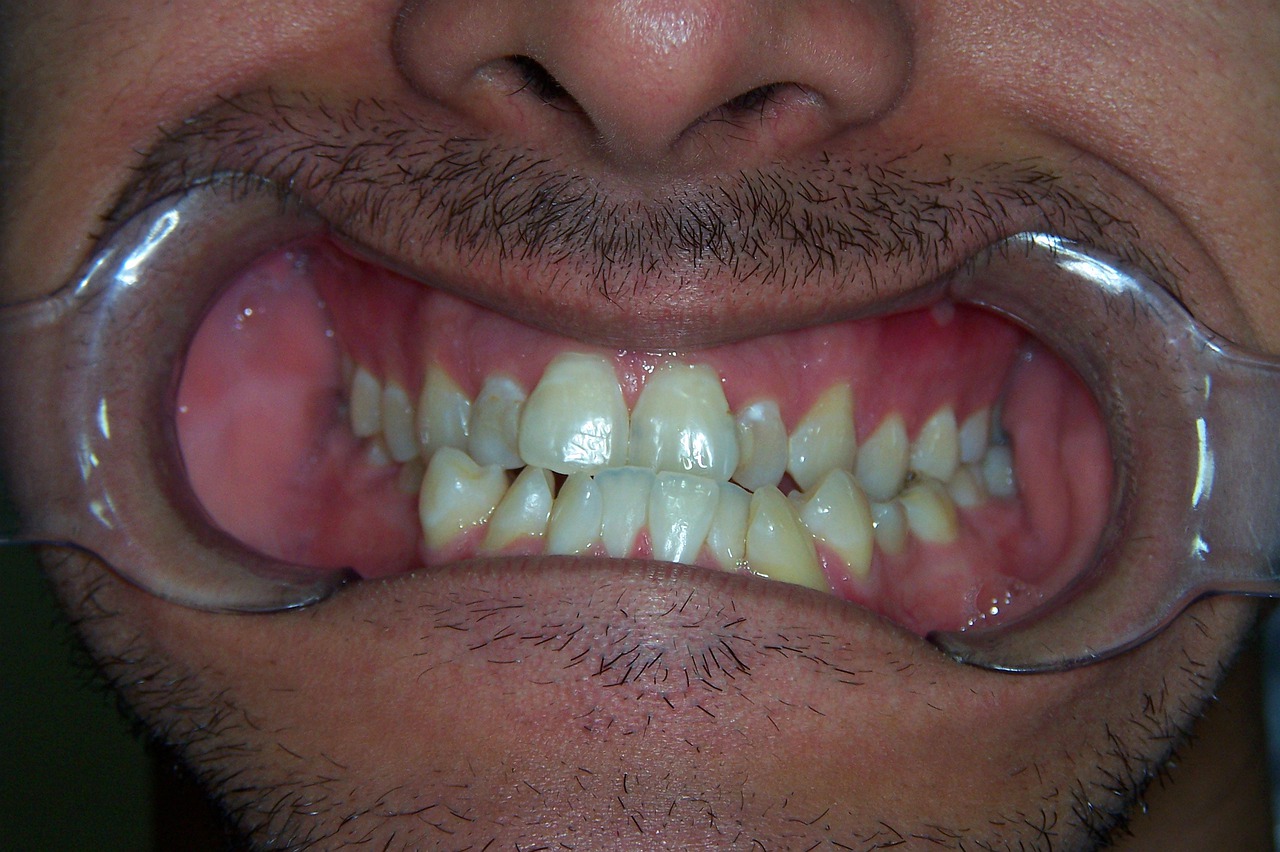 Crooked Teeth