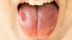 Dry Mouth with tongue wide open