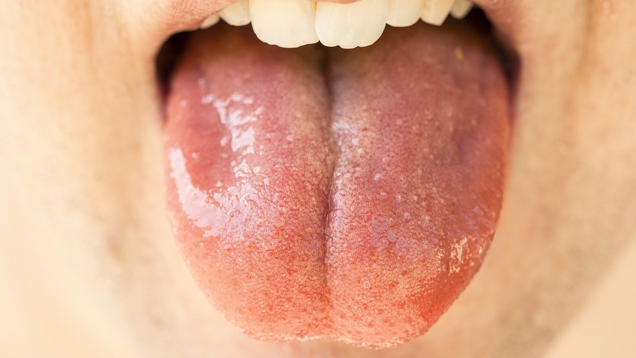 Dry Mouth with tongue wide open