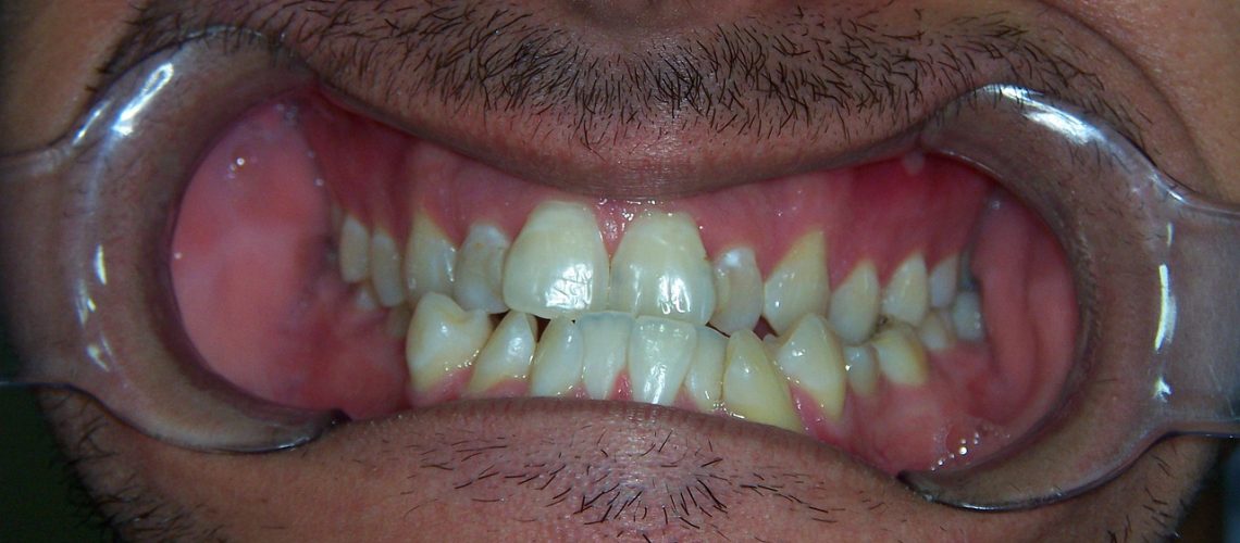 Crooked Teeth